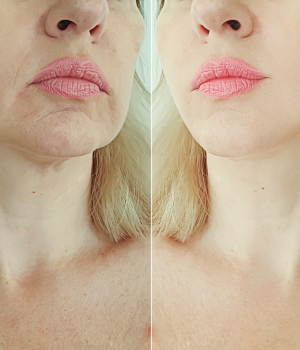 Rejuvenescimento facial 2